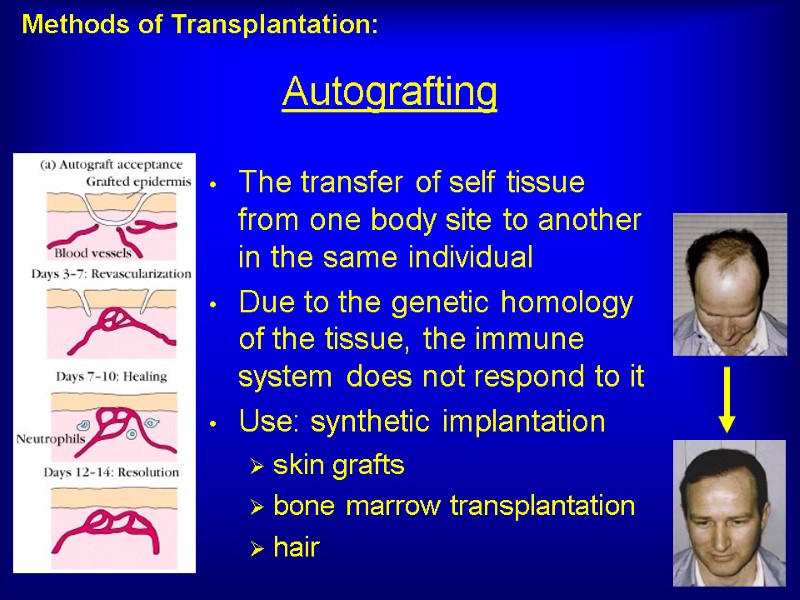 Autografting The transfer of self tissue from one body site to another in the